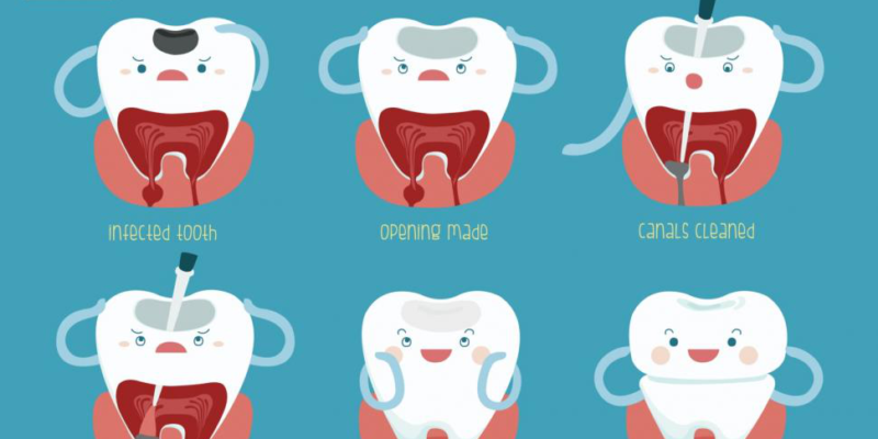 Myths Associated With Root Canals