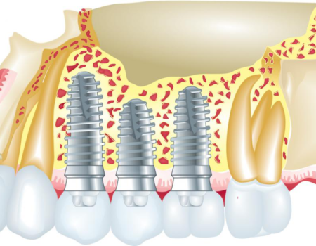 4 Myths about Dental Implants Debunked