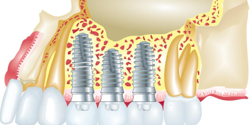 4 Myths about Dental Implants Debunked