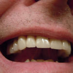 Aftercare for Dental Crowns
