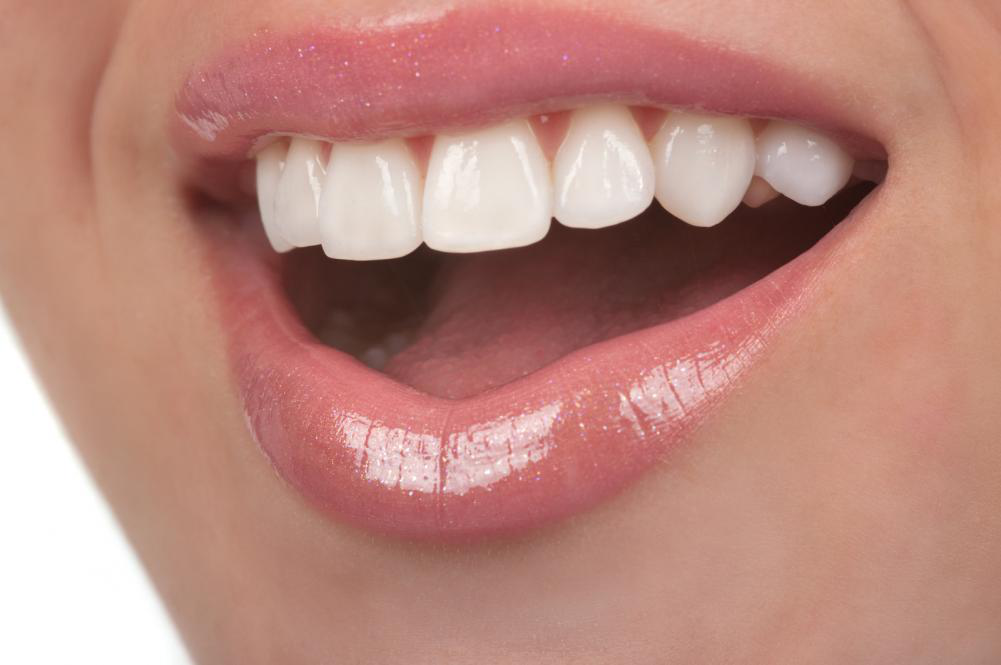 What are Dental Veneers?