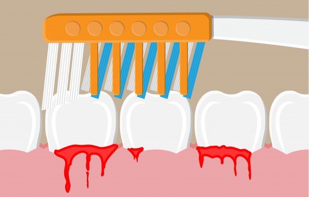 an illustration of bleeding gums while brushing teeth