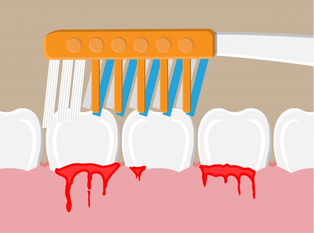 an illustration of bleeding gums while brushing teeth