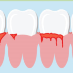 What You Need To Know About Gum Bleeding