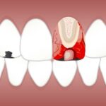 An animation of our teeth and gums showing the internal structure of a tooth
