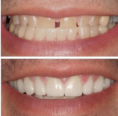 Difference between a dental crown and natural teeth