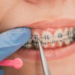 A person getting braces installed