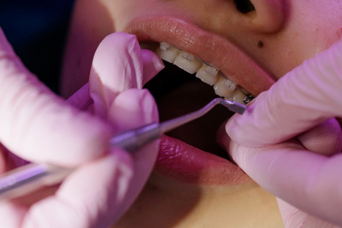 A dentist putting braces on a patient