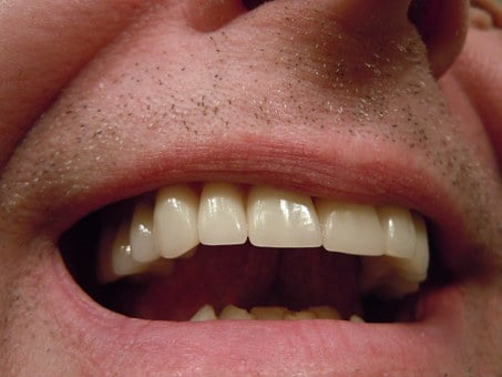 A Picture of a Man’s Dental Crowns 